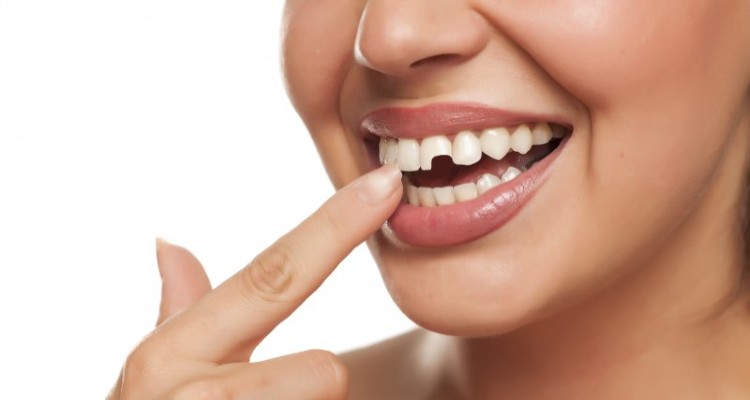 What To Do If You Break A Back Tooth